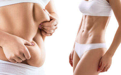 Liposuzione e liposcultura