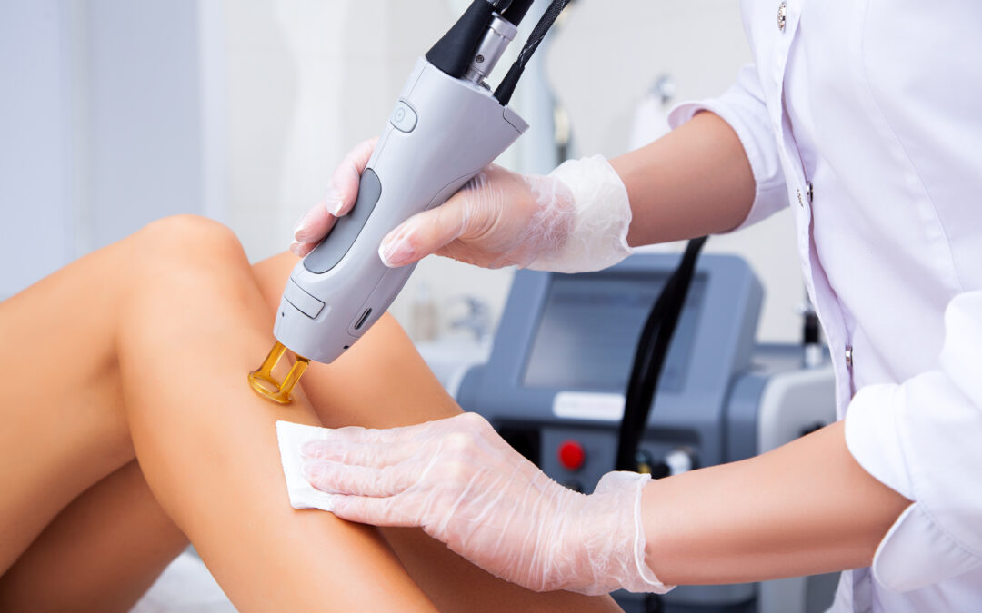 Depilazione laser