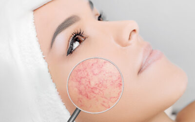 Come eliminare i capillari e le macchie rosse dal viso con il laser KTP: la tecnologia rivoluzionaria che ti fa ringiovanire di 10 anni