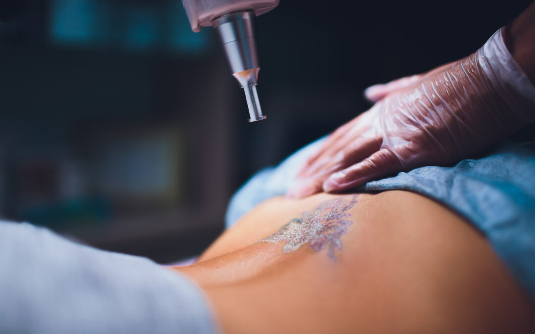 Rimozione tatuaggi