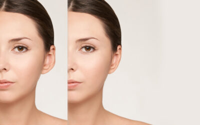 Otoplastica