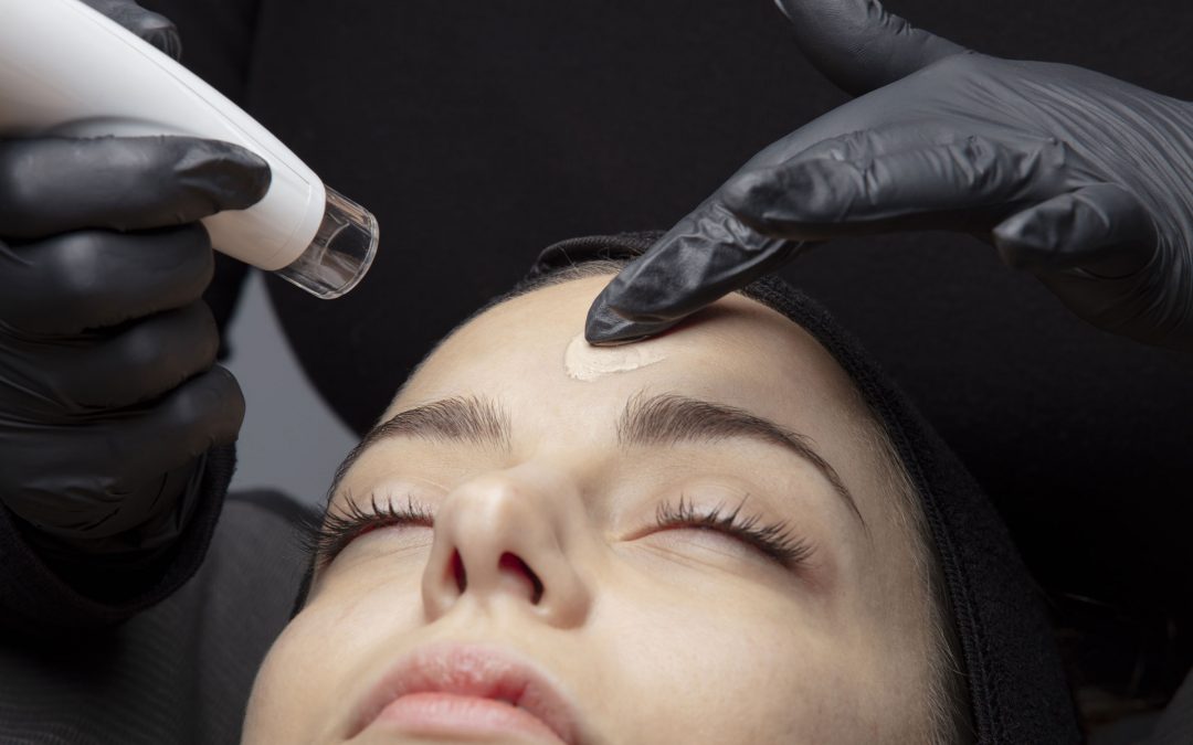 Come eliminare le cicatrici dell’acne con il laser Ultrapulse Lumenis®