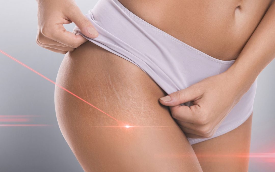 Trattamento delle smagliature