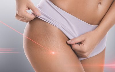 trattamento laser smagliature Roma